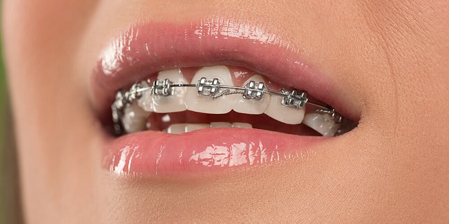 Traditional Braces Southcentre, Seton and Okotoks